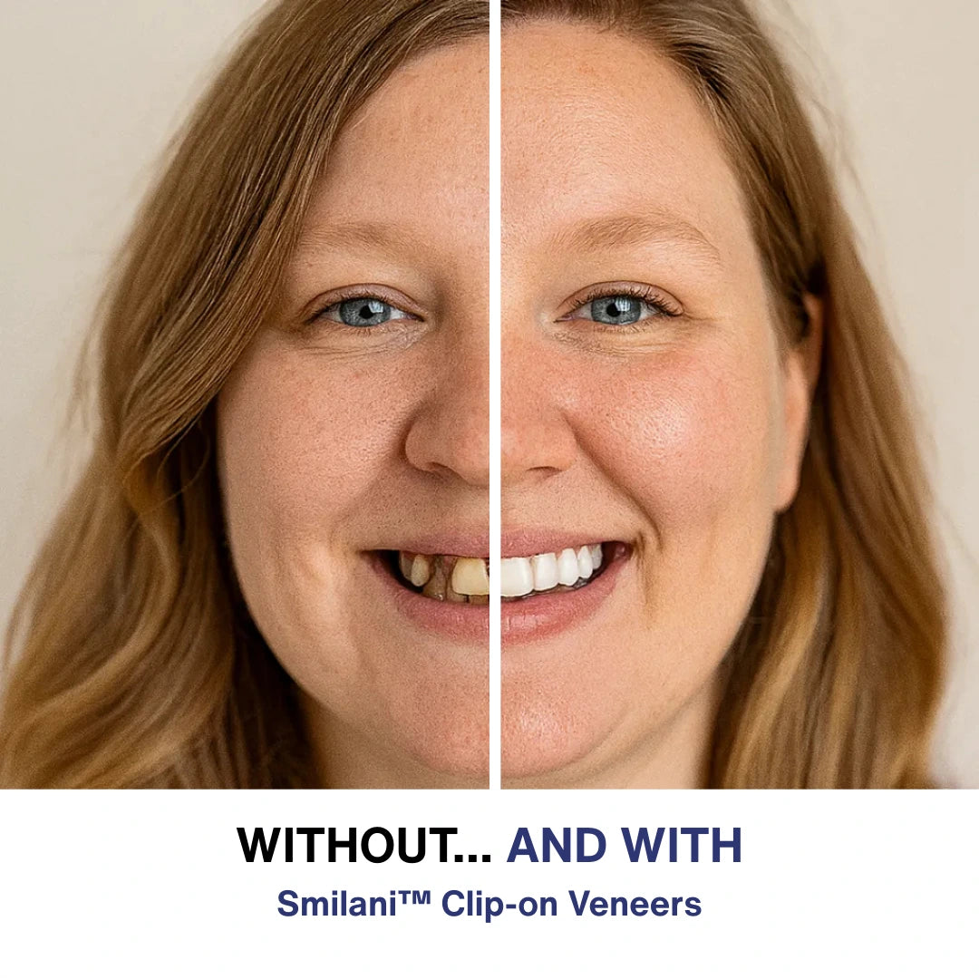 Smilani™ Clip-on Veneers
